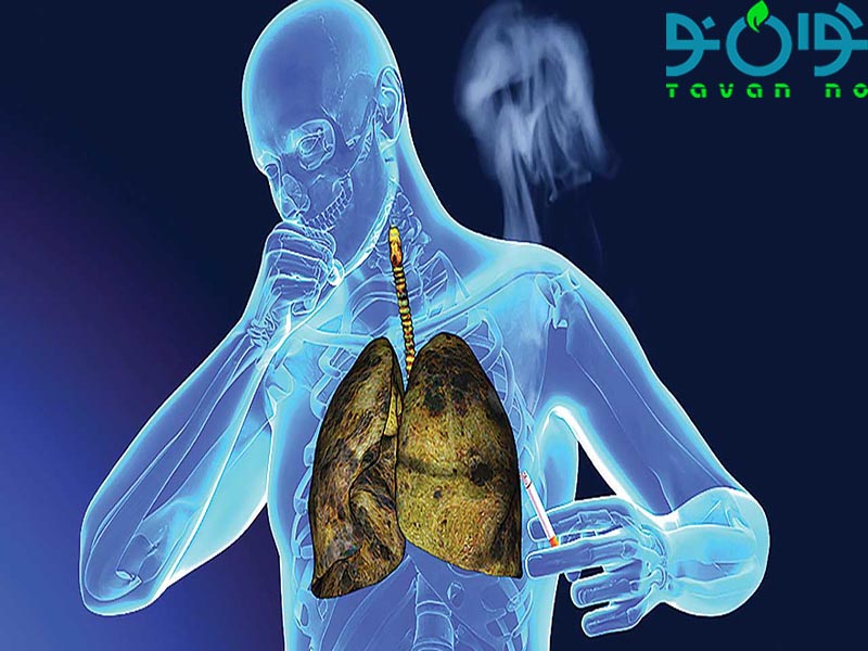 سرطان ریه چیست و آیا درمان دارد؟