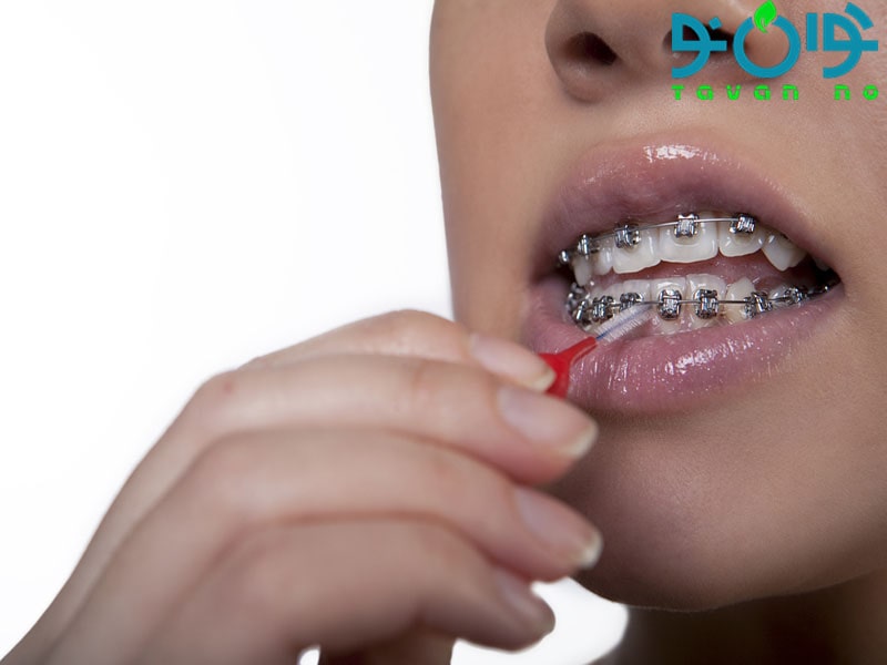 درمان پوسیدگی دندان در زمان ارتودنسی