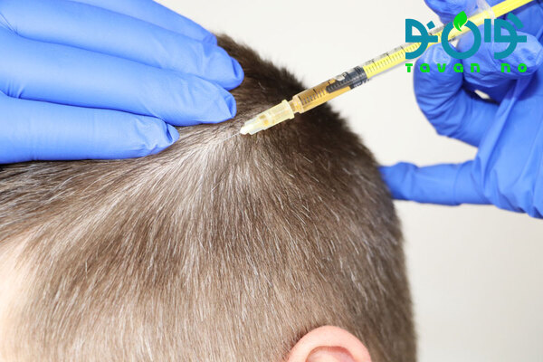 بهترین کوکتل مزوتراپی مو