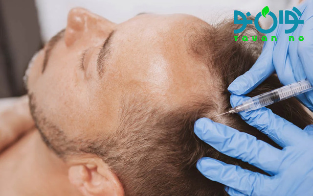 عوارض مزوتراپی مو