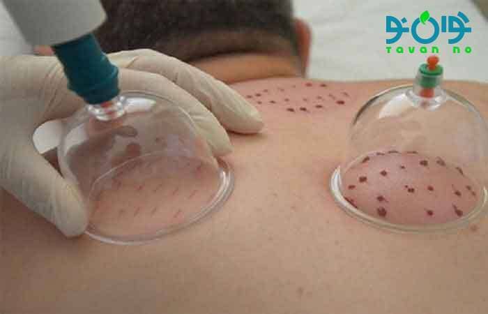 فواید حجامت