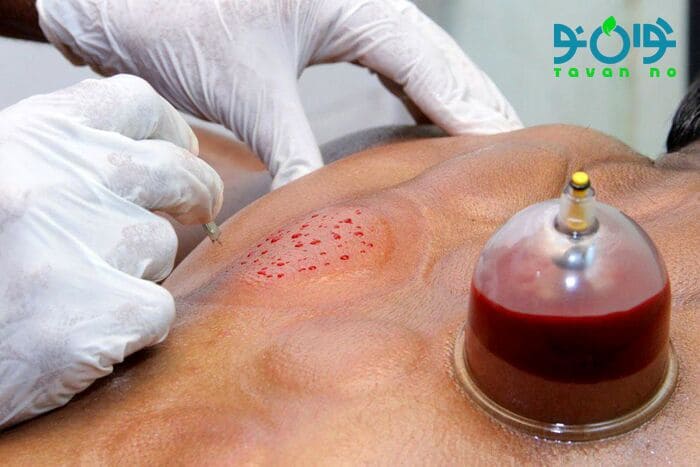 چه کسانی نباید حجامت کنند