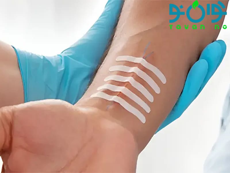 چسب بخیه چیست و در چه مواردی از آن استفاده می‌شود؟