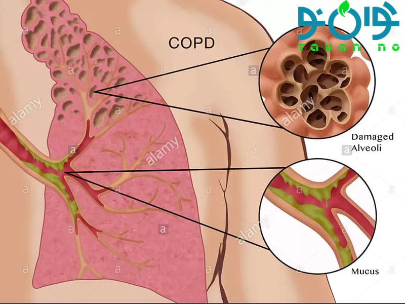 COPD چیست؟ علائم، علل، تشخیص، پیشگیری و درمان بیماری انسدادی مزمن ریه