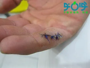 نخ بخیه جذبی