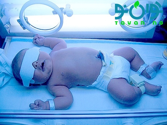 اجاره دستگاه زردی نوزاد